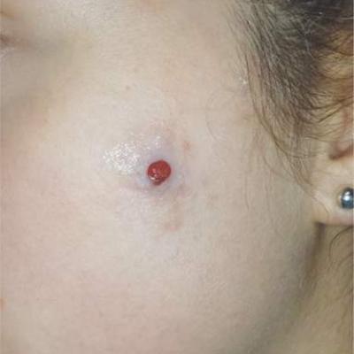 Lesion Is Tender And Bleeds Copiously Clinician Reviews