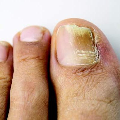 Combine topicals, orals for onychomycosis | MDedge Dermatology