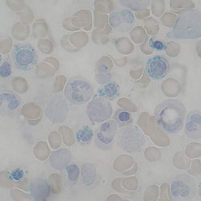 Genetic mutation identifies favorable prognosis MDS | MDedge Hematology ...