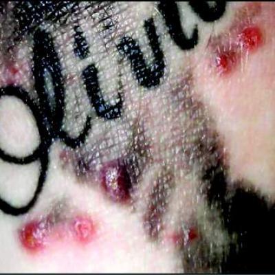 Tattoo Removal  Dermatologist in Lake Worth FL  Palm Beach Dermatology