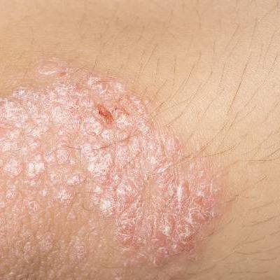 Psoriasis and acne worse in winter, milder in summer | MDedge Dermatology