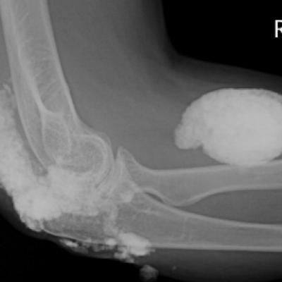 Calcinosis universalis | Journal of Hospital Medicine