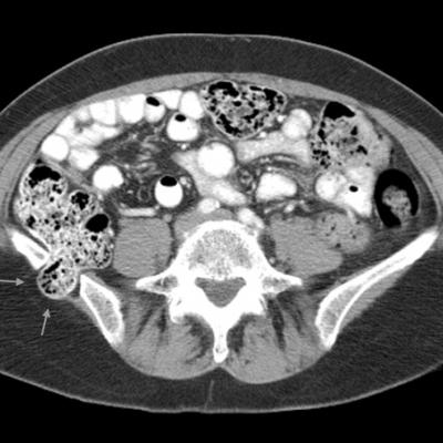 Incisional Iliac Hernia | Journal of Hospital Medicine