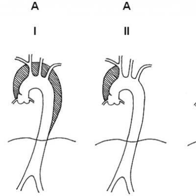 Acute Aortic Dissection | Journal of Hospital Medicine