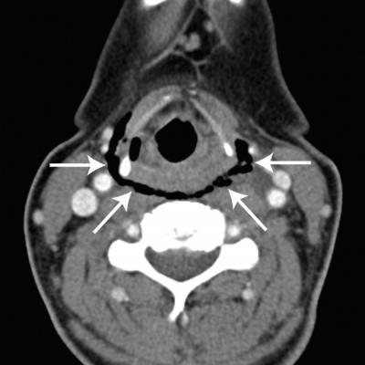 Esophageal Perforation, Complication of EGD | Journal of Hospital Medicine