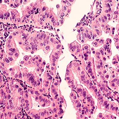 2019 Update on gynecologic cancer | MDedge ObGyn