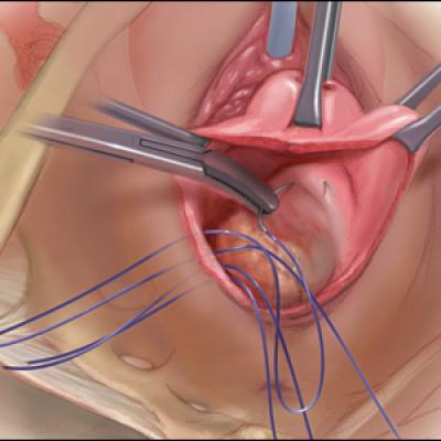 Options and outcomes for uterine preservation at the time of prolapse  surgery