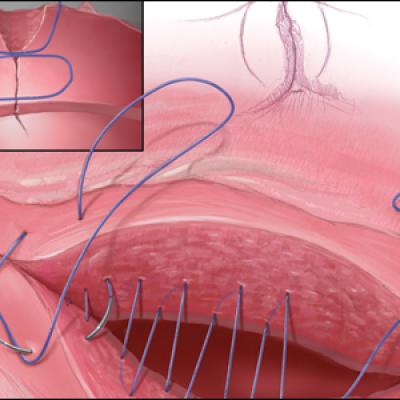 Uterine incision closure: Is it the culprit in the cesarean scar niche ...