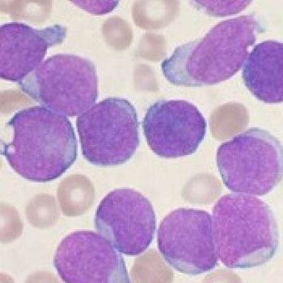 Antibody Shows Potential For Treating AML, B-ALL | MDedge Hematology ...