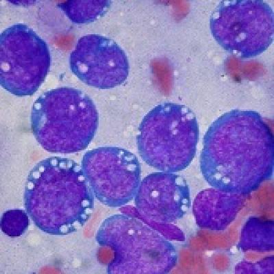 How Malaria Increases The Risk Of Burkitt Lymphoma Mdedge Hematology And Oncology