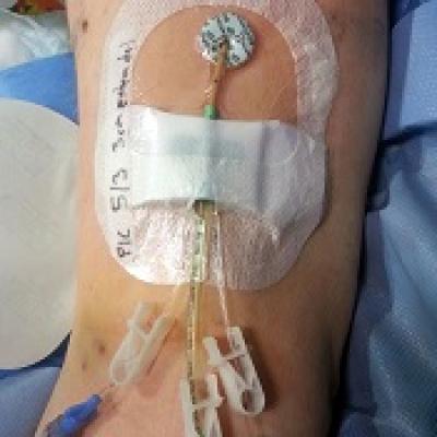 Picl Injection Group creates guide for PICC use | MDedge Hematology and Oncology