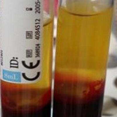 Test for HIT receives CE mark | MDedge Hematology and Oncology