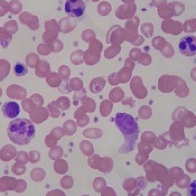 Drug Won T Advance To Phase 3 In Ss Thalassemia Mdedge Hematology And Oncology