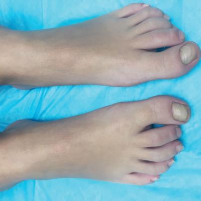 malaligned great toenails web