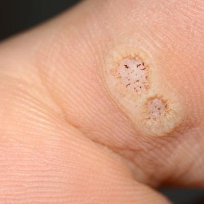 Warts difficult to eradicate in immunocompromised children | MDedge ...