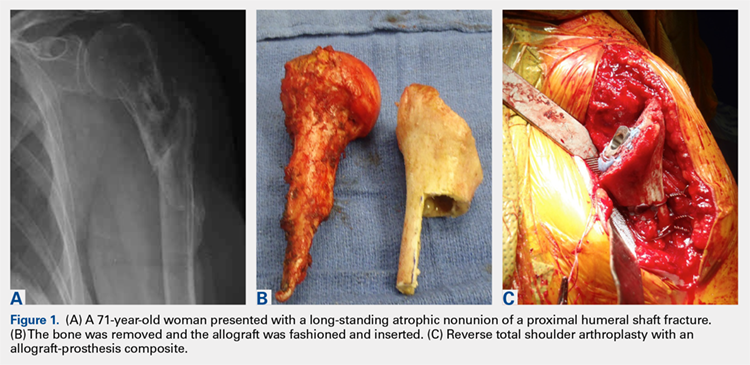 A 71-year-old woman presented with a long-standing atrophic nonunion of a proximal humeral shaft fracture