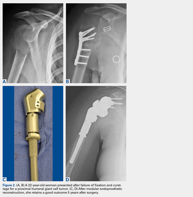 A 22-year-old woman presented after failure of fixation and curettage for a proximal humeral giant cell tumor