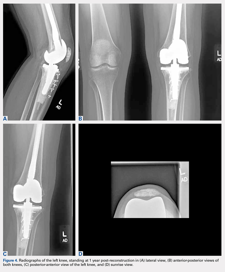 Mycobacterium abscessus: A Rare Cause of Periprosthetic Knee Joint ...