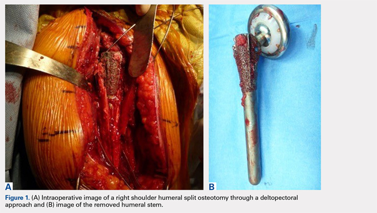 (A) Intraoperative image of a right shoulder humeral split osteotomy through a deltopectoral approach and (B) image of the removed humeral stem.