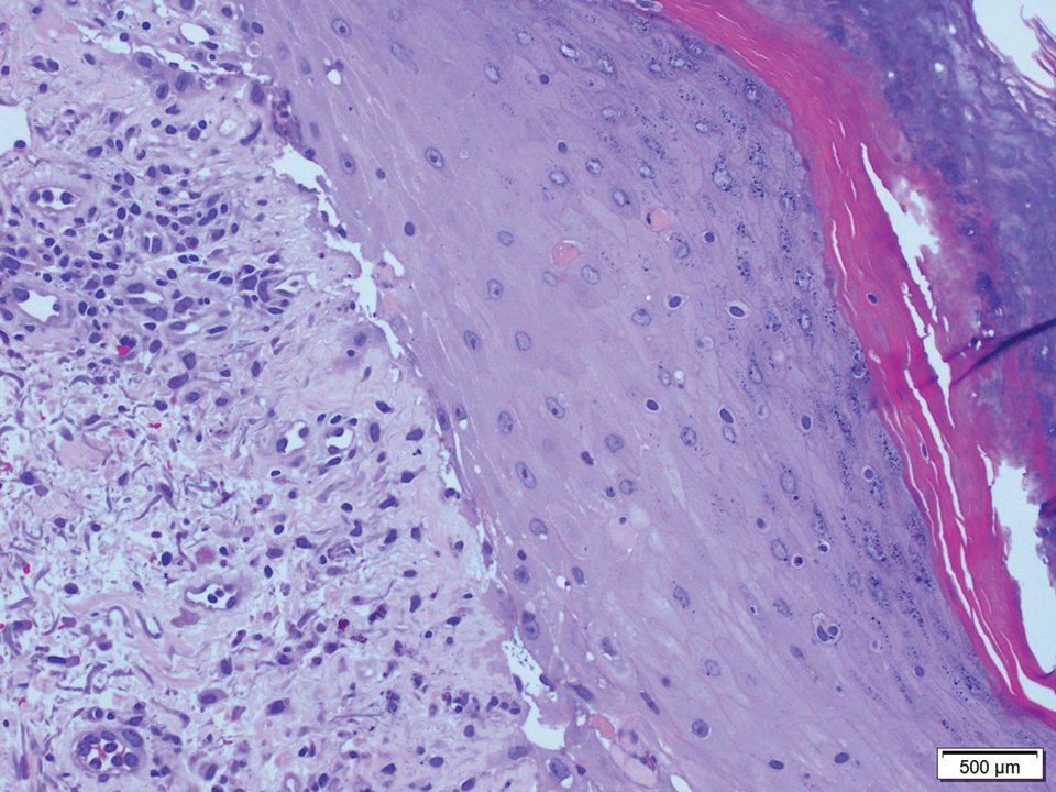 Vacuolar interface with scattered necrotic keratinocytes within an acanthotic epidermis with hyperkeratosis and wedge-shaped hypergranulosis