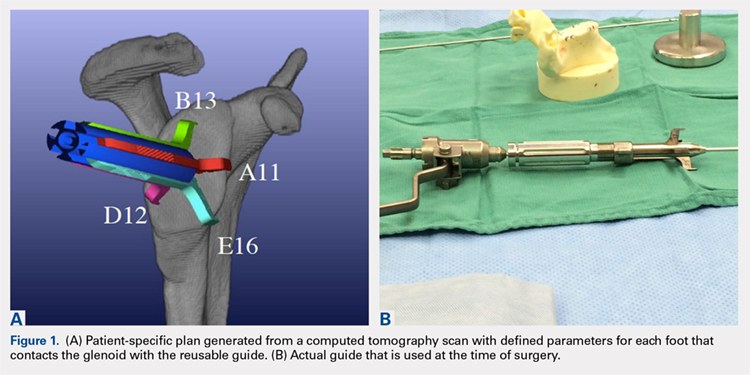 (A) Patient-specific plan generated from a computed tomography scan with defined parameters for each foot that contacts the glenoid with the resuable guide. (B) Actual guide that is used at the time of surgery.