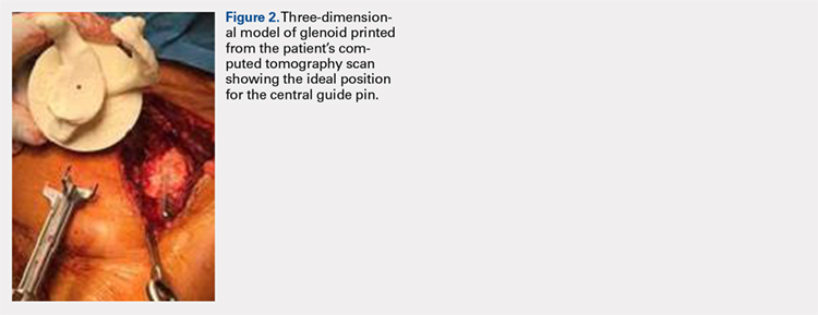 Three-dimensional model of glenoid printed from the patient's computed tomography scan showing the ideal position for the central guide pin.