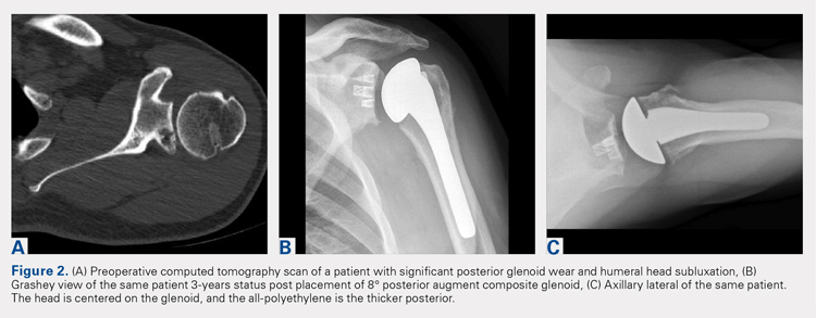 Preoperative computed tomography scan of a patient with significant posterior glenoid wear and humeral head subluxation