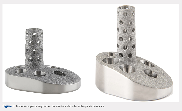 Posterior-superior augmented reverse total shoulder arthroplasty baseplate