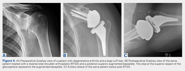 Preoperative Grashey view of a patient with degenerative arthritis and a large cuff tear